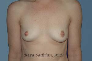 Breast Augmentation Before & After Image