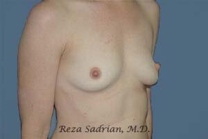 Breast Augmentation Before & After Image