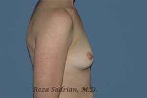 Breast Augmentation Before & After Image