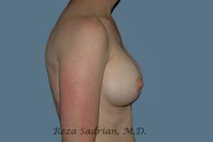 Breast Augmentation Before & After Image