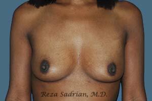 Breast Augmentation Before & After Image