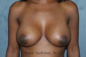 Breast Augmentation Before & After Image