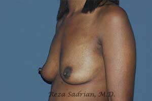 Breast Augmentation Before & After Image