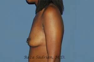 Breast Augmentation Before & After Image