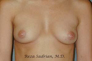 Breast Augmentation Before & After Image