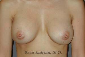 Breast Augmentation Before & After Image