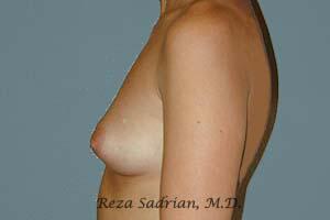 Breast Augmentation Before & After Image