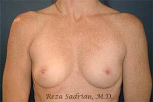 Breast Augmentation Before & After Image