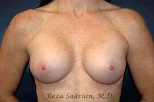 Breast Augmentation Before & After Image