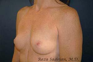 Breast Augmentation Before & After Image