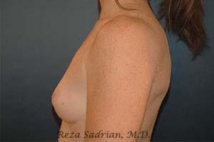 Breast Augmentation Before & After Image