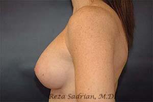 Breast Augmentation Before & After Image