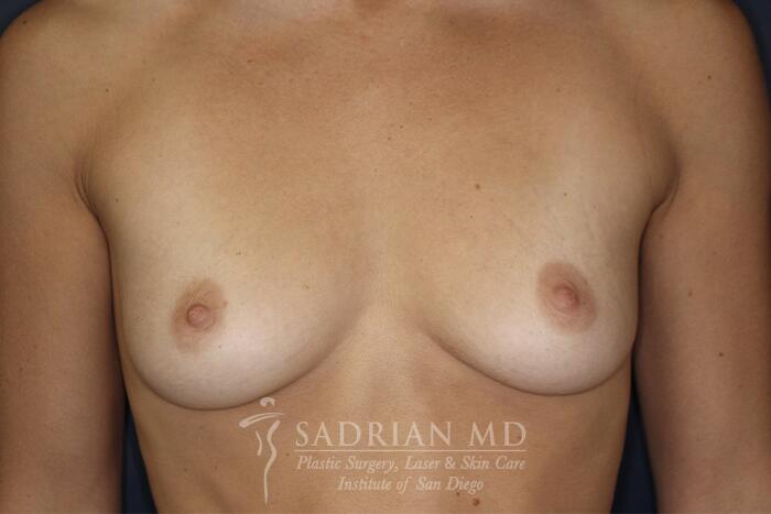 Breast Augmentation Before & After Image