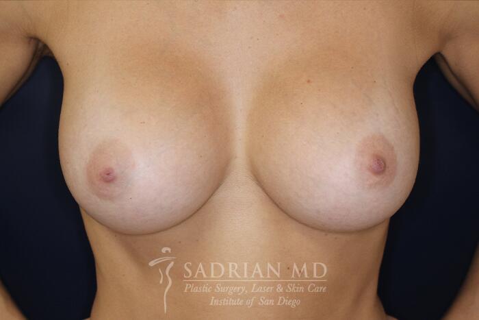 Breast Augmentation Before & After Image