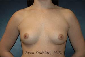 Breast Augmentation Before & After Image