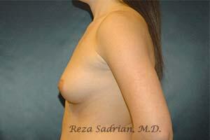 Breast Augmentation Before & After Image