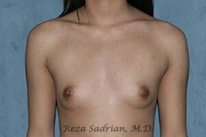 Breast Augmentation Before & After Image