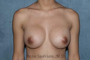 Breast Augmentation Before & After Image