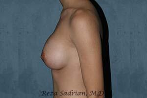 Breast Augmentation Before & After Image