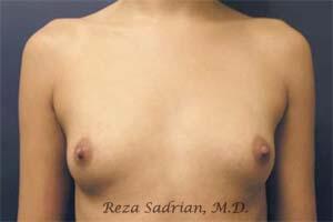 Breast Augmentation Before & After Image