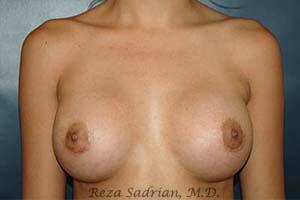 Breast Augmentation Before & After Image