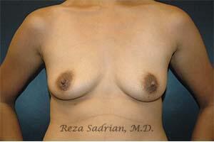 Breast Augmentation Before & After Image