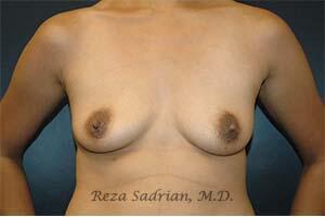 Breast Augmentation Before & After Image