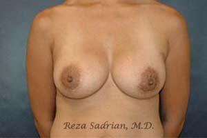 Breast Augmentation Before & After Image