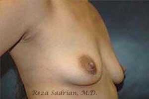 Breast Augmentation Before & After Image