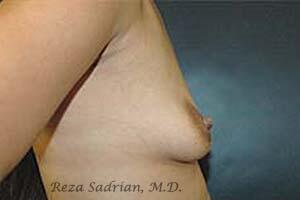 Breast Augmentation Before & After Image