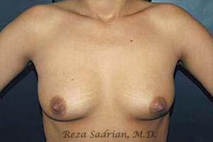 Breast Augmentation Before & After Image