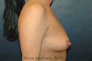 Breast Augmentation Before & After Image