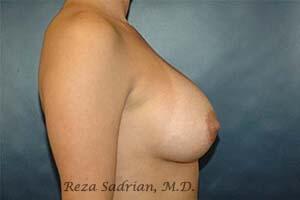 Breast Augmentation Before & After Image