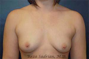 Breast Augmentation Before & After Image