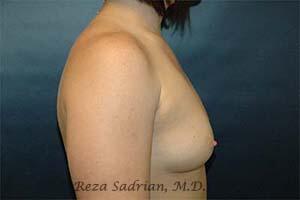 Breast Augmentation Before & After Image