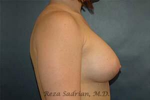 Breast Augmentation Before & After Image