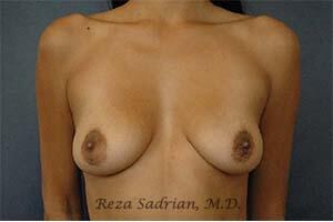 Breast Augmentation Before & After Image