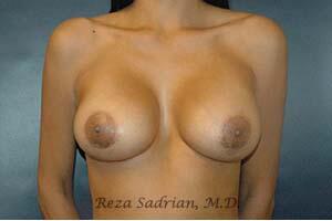 Breast Augmentation Before & After Image