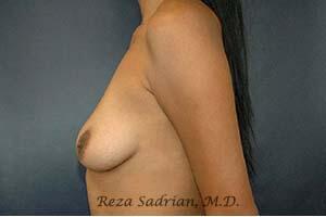 Breast Augmentation Before & After Image