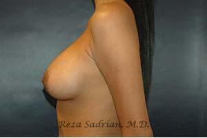 Breast Augmentation Before & After Image