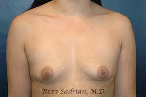 Breast Augmentation Before & After Image