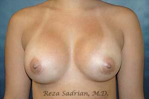 Breast Augmentation Before & After Image