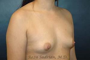 Breast Augmentation Before & After Image