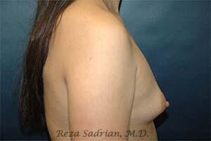 Breast Augmentation Before & After Image