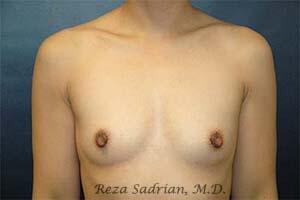 Breast Augmentation Before & After Image