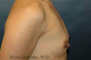 Breast Augmentation Before & After Image