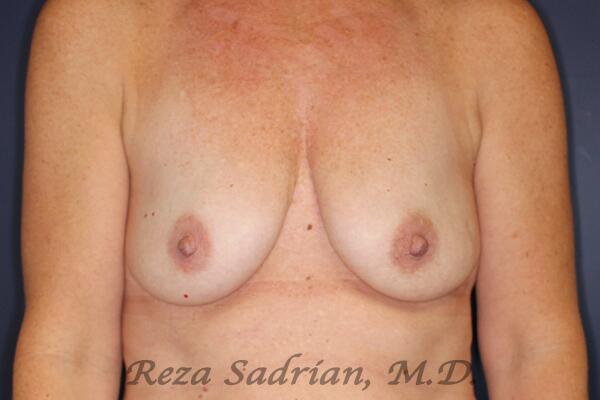 Breast Augmentation Before & After Image