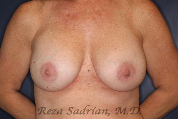 Breast Augmentation Before & After Image