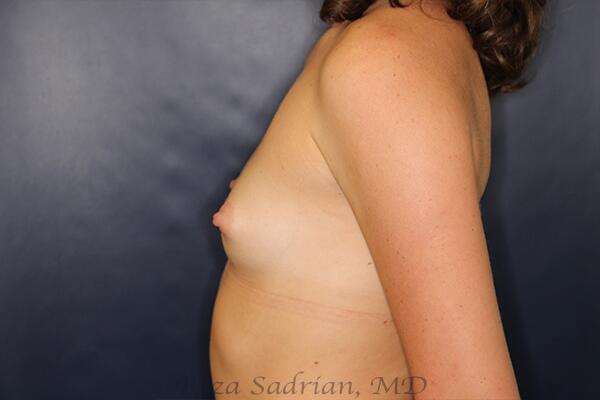 Breast Augmentation Before & After Image