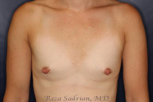 Breast Augmentation Before & After Image